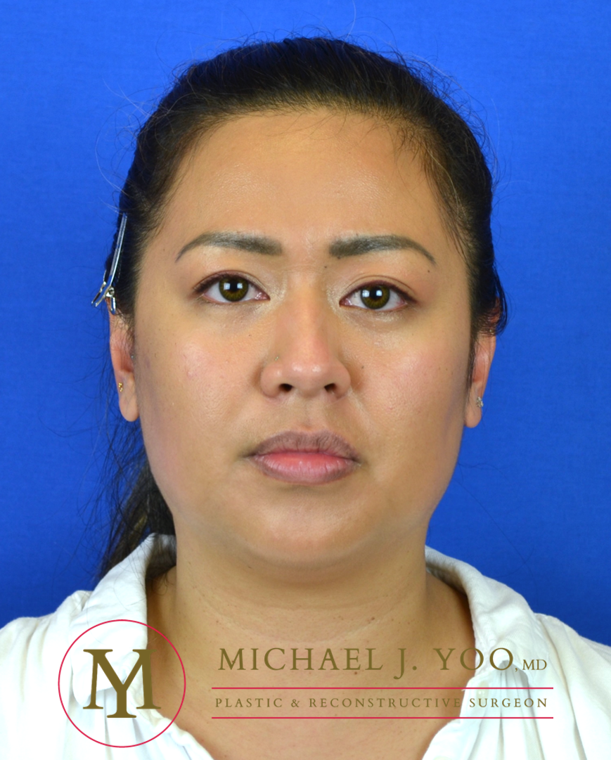 Facial Liposculpture Before & After Patient #3280