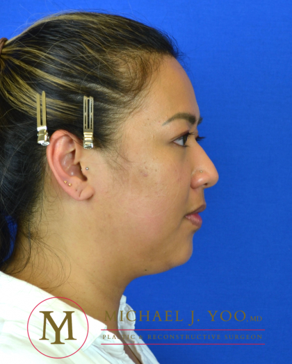 Facial Liposculpture Before & After Patient #3280