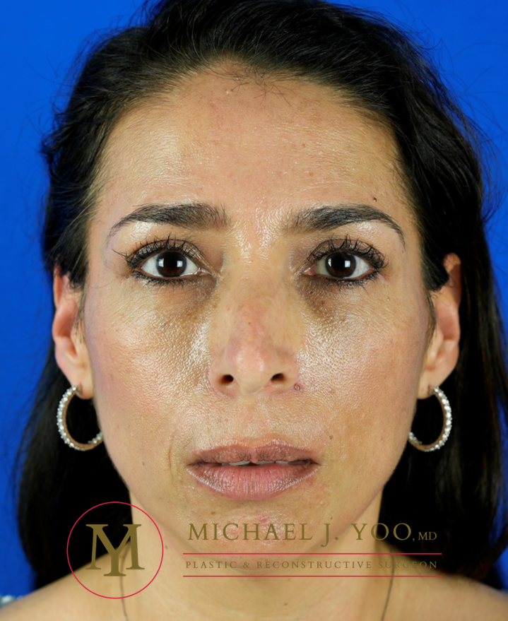 Fillers Before & After Patient #3346