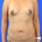Tummy Tuck Before & After Patient #3330