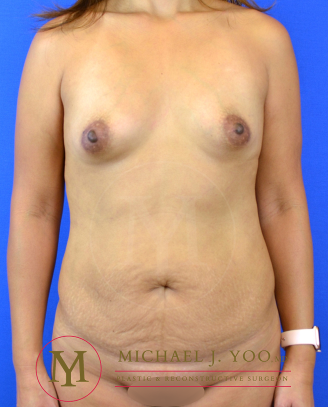 Tummy Tuck Before & After Patient #3330