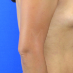 Arm Liposuction Before & After Patient #3318