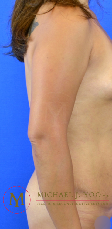 Arm Liposuction Before & After Patient #3318