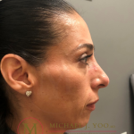 Fillers Before & After Patient #3346