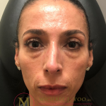 Fillers Before & After Patient #3346