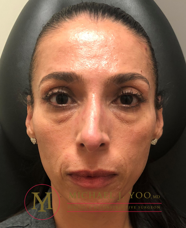 Fillers Before & After Patient #3346