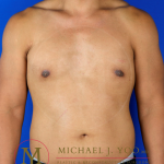 Areola Reduction Before & After Patient #3366