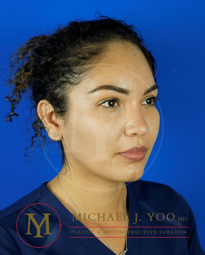 Forehead Reduction Before & After Patient #3411