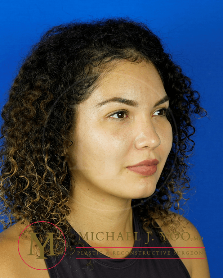 Forehead Reduction Before & After Patient #3411