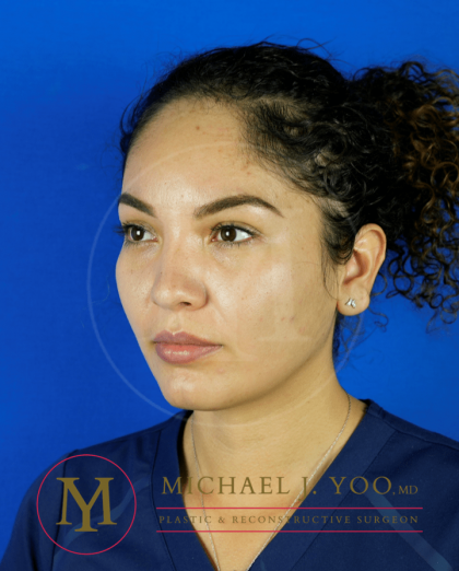 Forehead Reduction Before & After Patient #3411