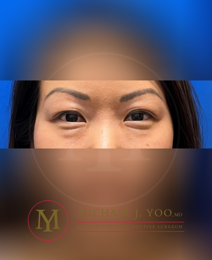 Lower Eyelid Lift Before & After Patient #3429