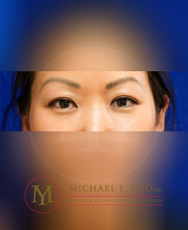 Lower Eyelid Lift Before & After Patient #3429