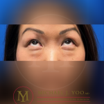 Lower Eyelid Lift Before & After Patient #3429