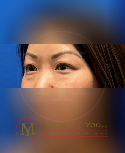 Lower Eyelid Lift Before & After Patient #3429