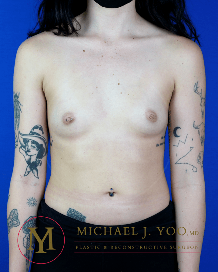 Breast Augmentation Before & After Patient #3461