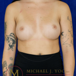 Breast Augmentation Before & After Patient #3461