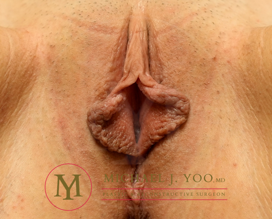 Labiaplasty Before & After Patient #3474