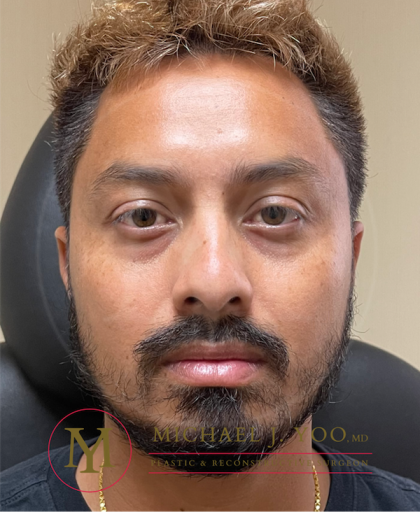 Lower Eyelid Lift Before & After Patient #3489