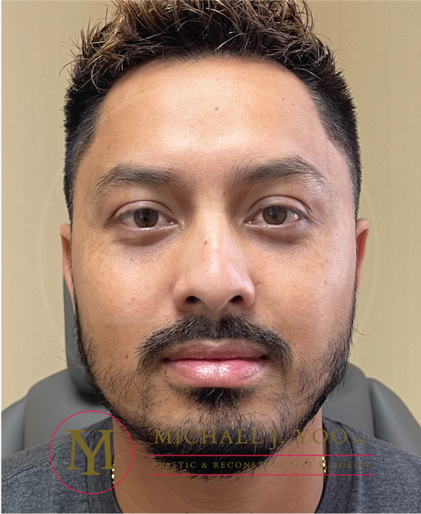 Lower Eyelid Lift Before & After Patient #3489