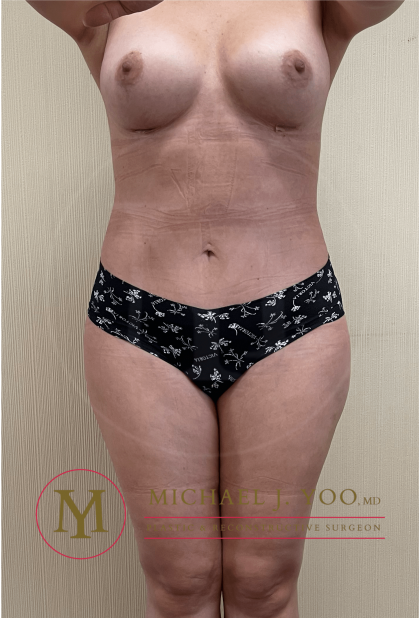Liposuction Before & After Patient #3502
