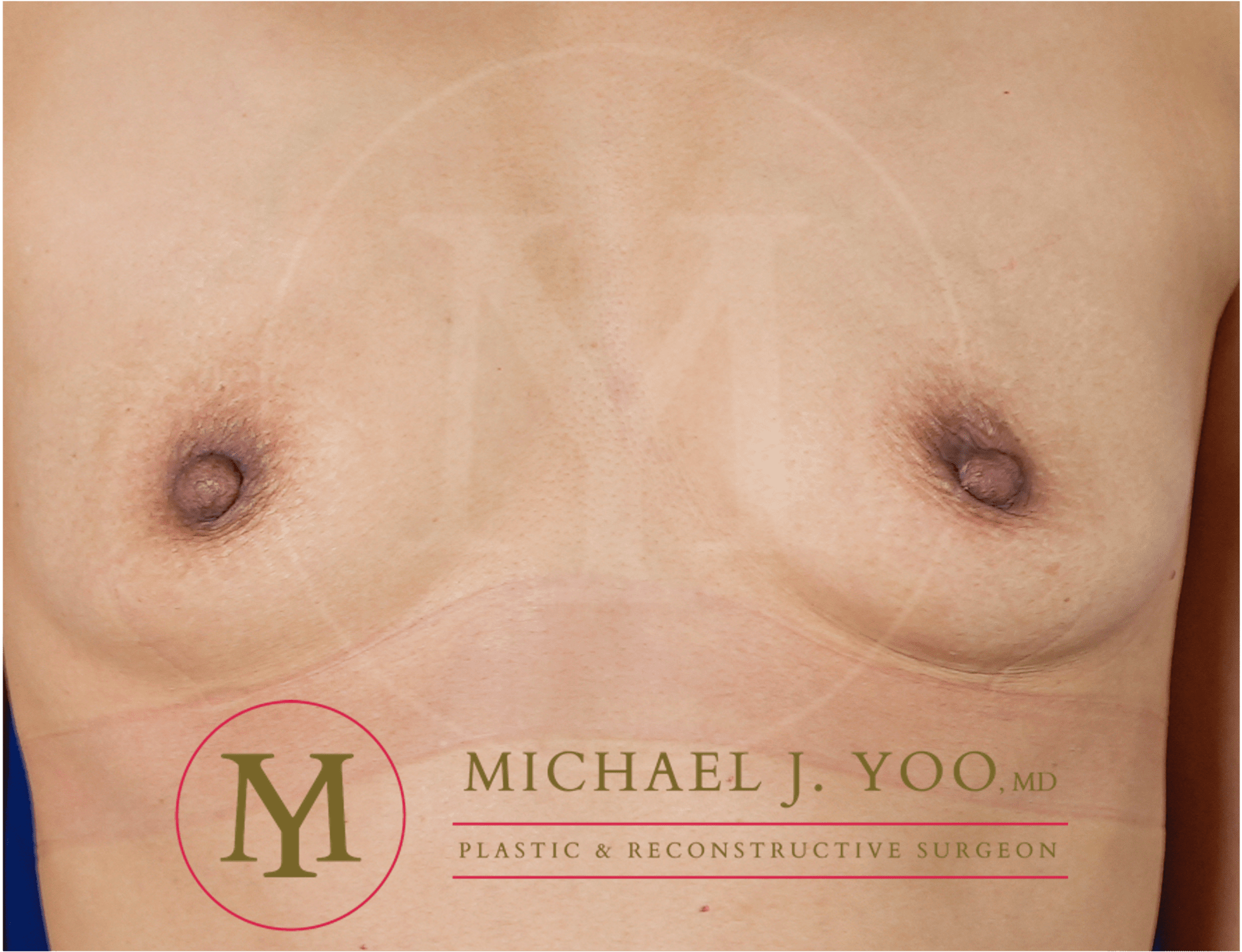 Nipple Reduction Before & After Patient #3513
