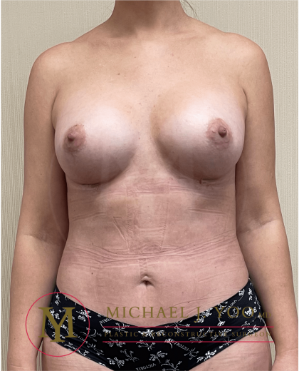 Breast Augmentation Before & After Patient #3495