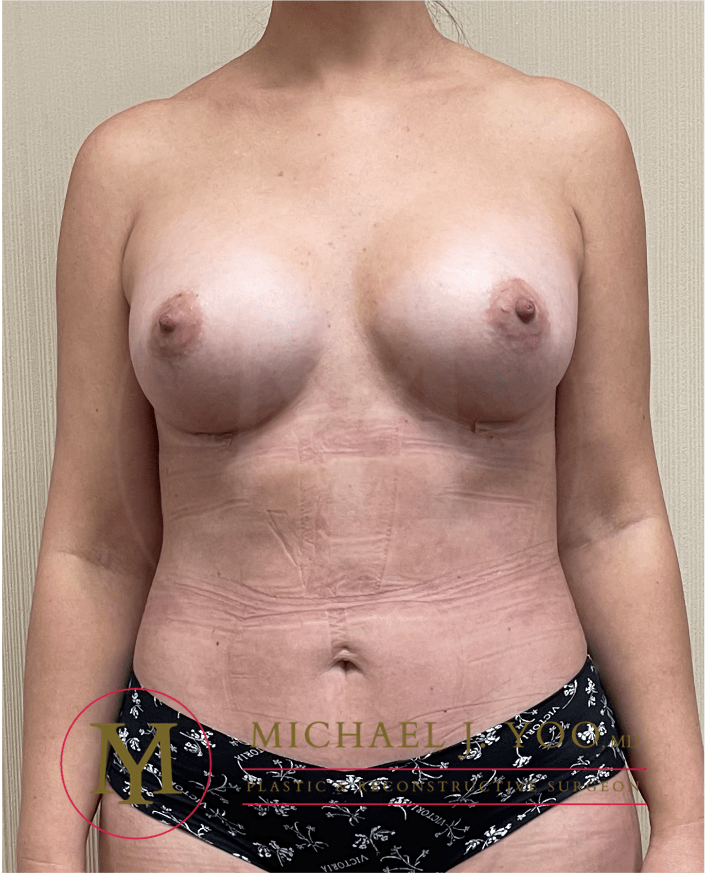 Breast Augmentation Before & After Patient #3495