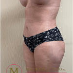 Tummy Tuck Before & After Patient #3543