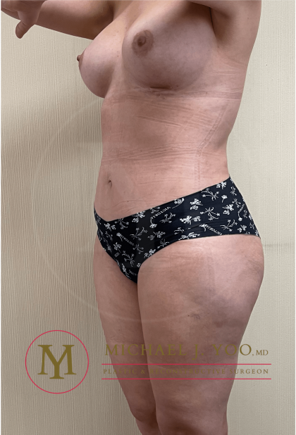 Liposuction Before & After Patient #3502