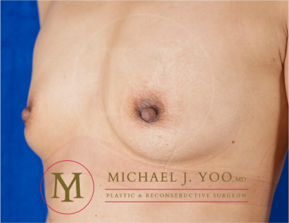 Nipple Reduction Before & After Patient #3513