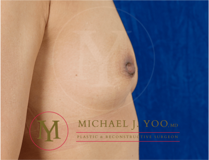 Nipple Reduction Before & After Patient #3513