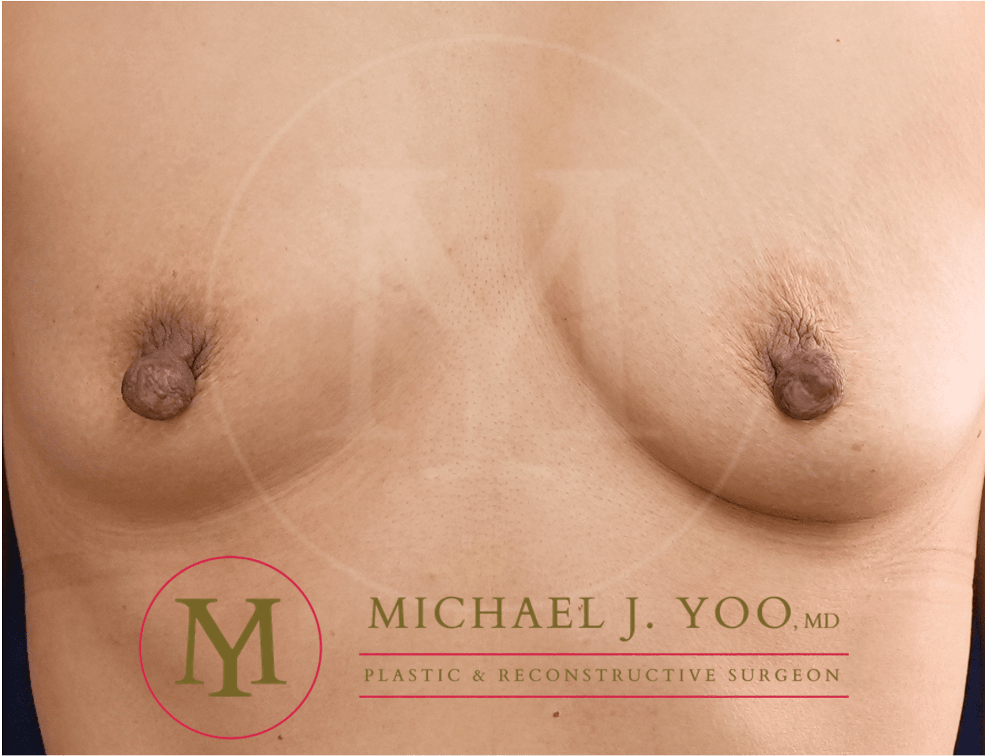 Nipple Reduction Before & After Patient #3513