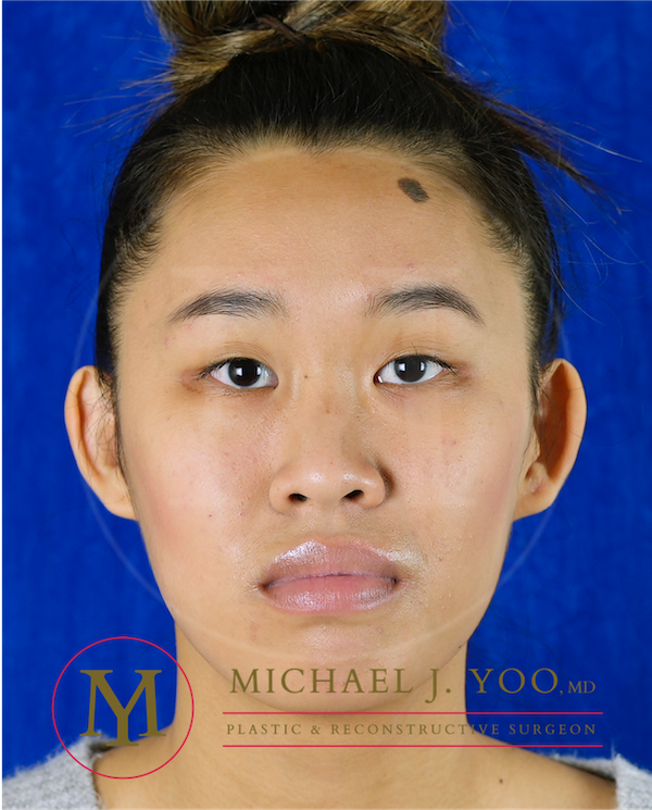 Otoplasty Before & After Patient #3559