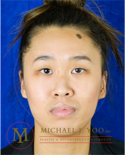 Otoplasty Before & After Patient #3559