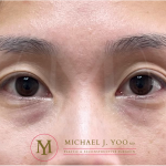 Under-eye Fillers Before & After Patient #3579