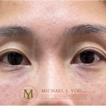 Under-eye Fillers Before & After Patient #3579