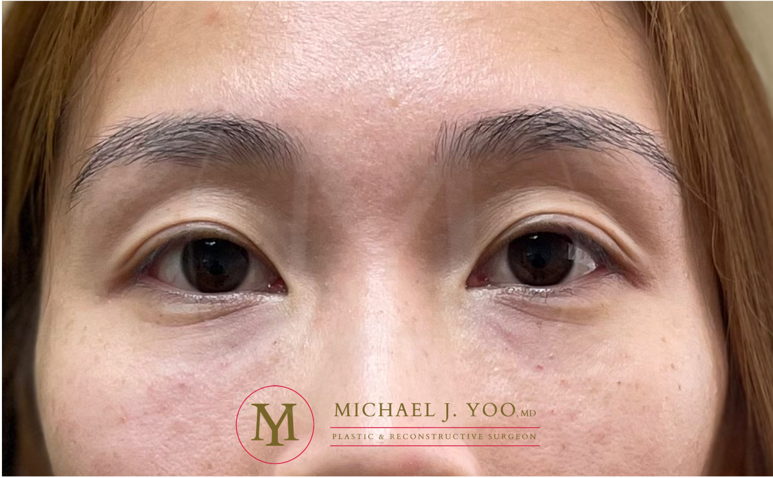 Under-eye Fillers Before & After Patient #3579
