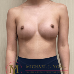 Breast Augmentation Before & After Patient #3600