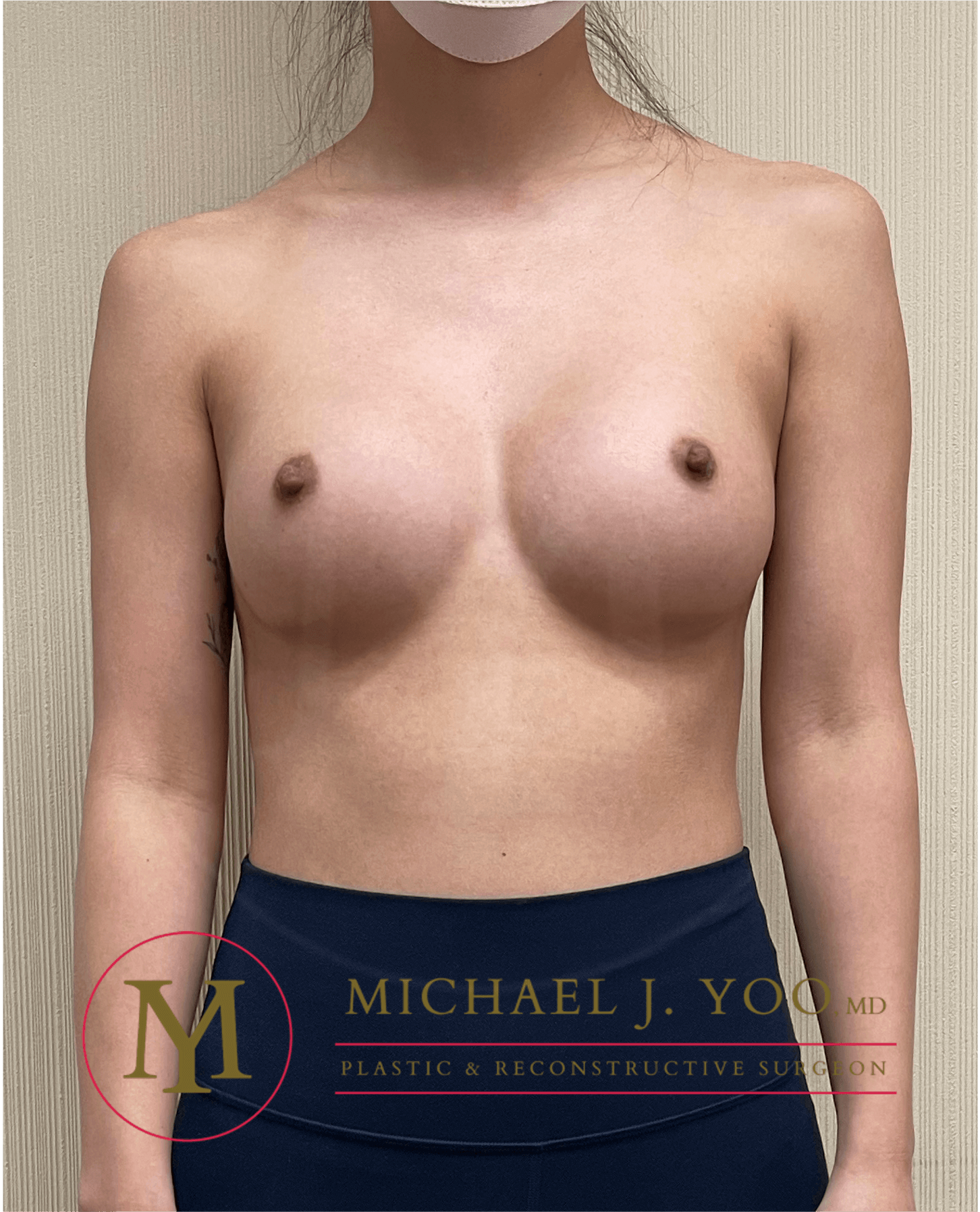 Breast Augmentation Before & After Patient #3600