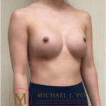 Breast Augmentation Before & After Patient #3600