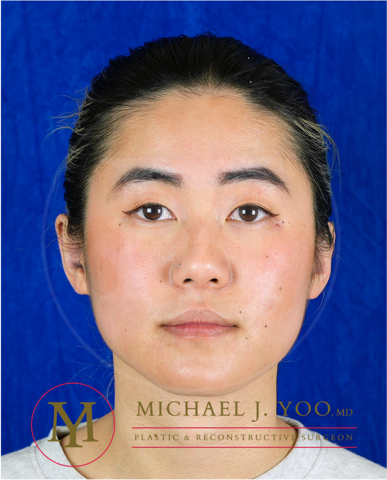 Otoplasty Before & After Patient #3585