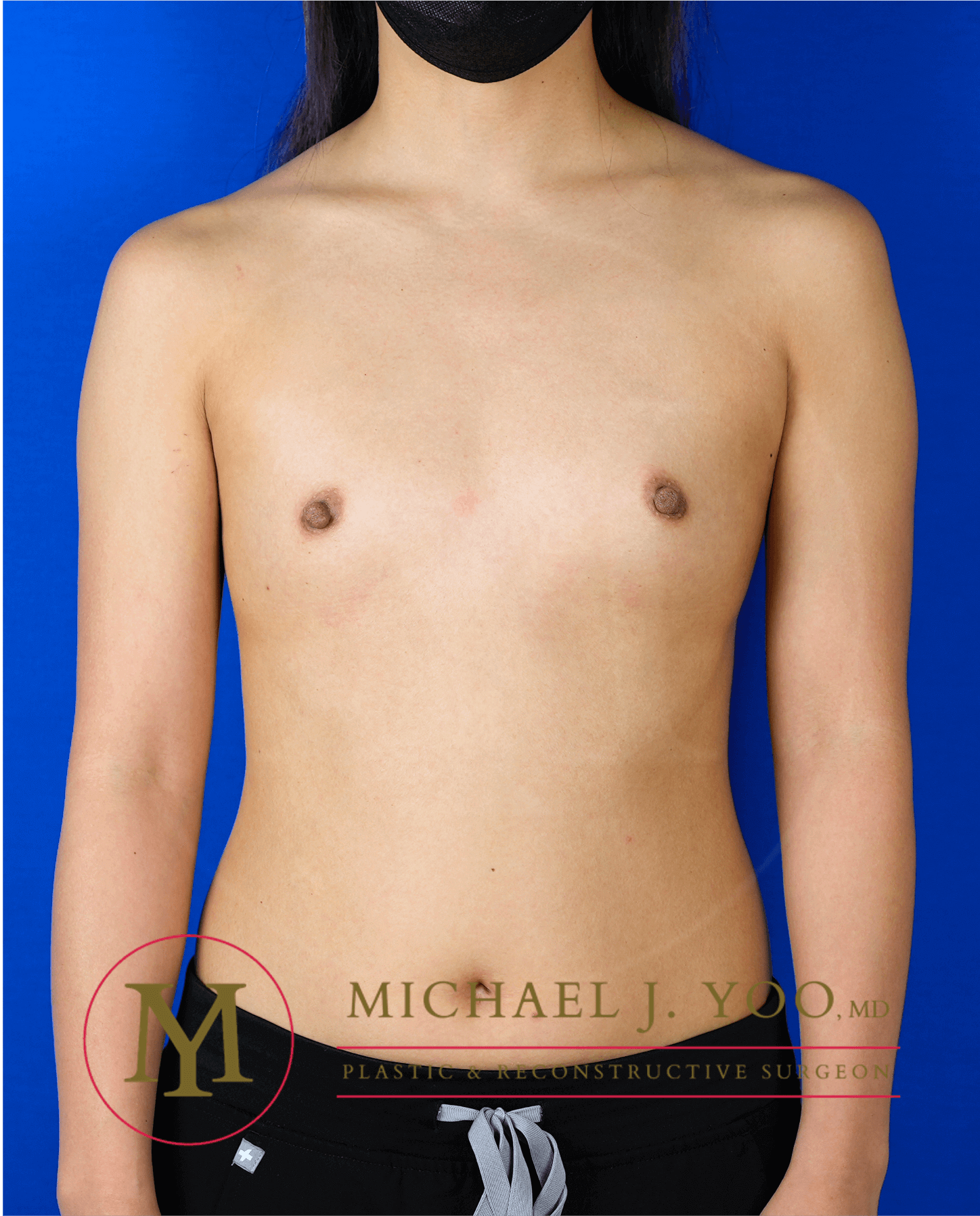 Breast Augmentation Before & After Patient #3600