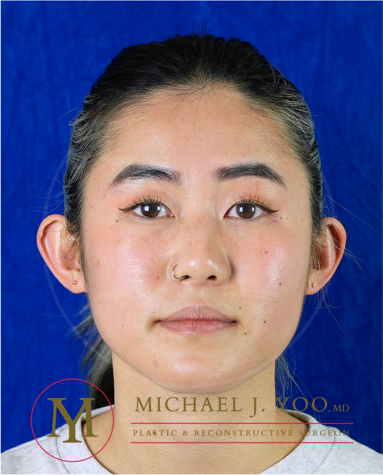 Otoplasty Before & After Patient #3585