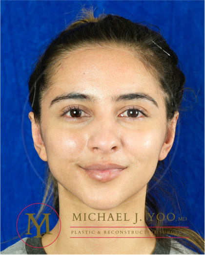 Otoplasty Before & After Patient #3607