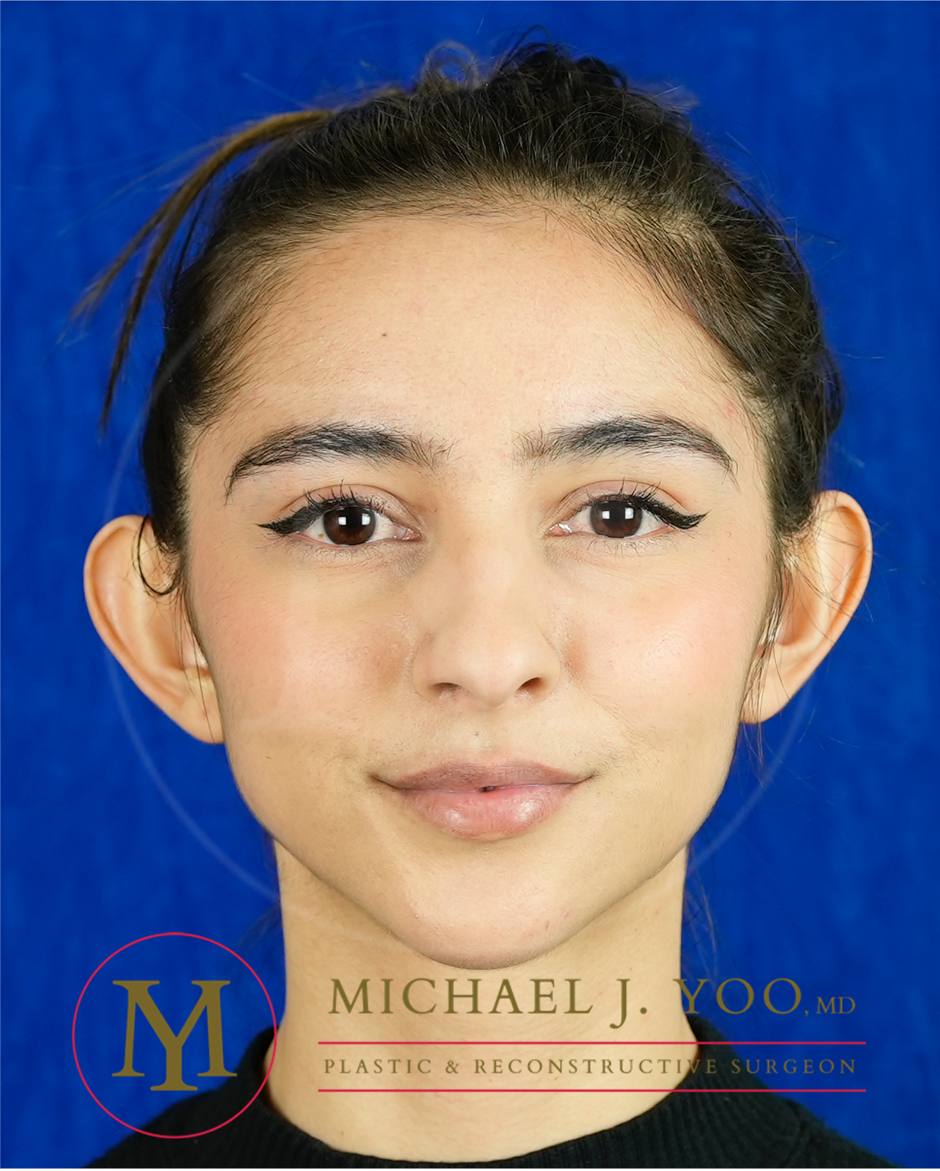 Otoplasty Before & After Patient #3607