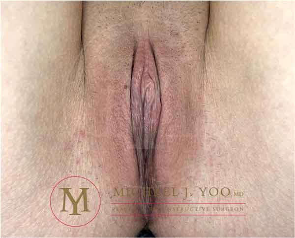 Labiaplasty Before & After Patient #3620