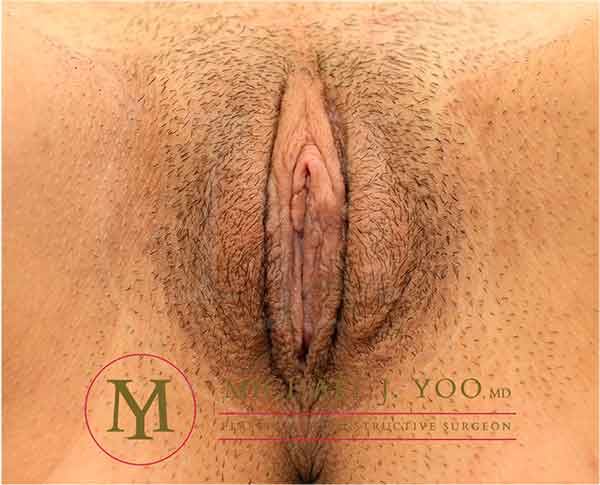 Labiaplasty Before & After Patient #3617