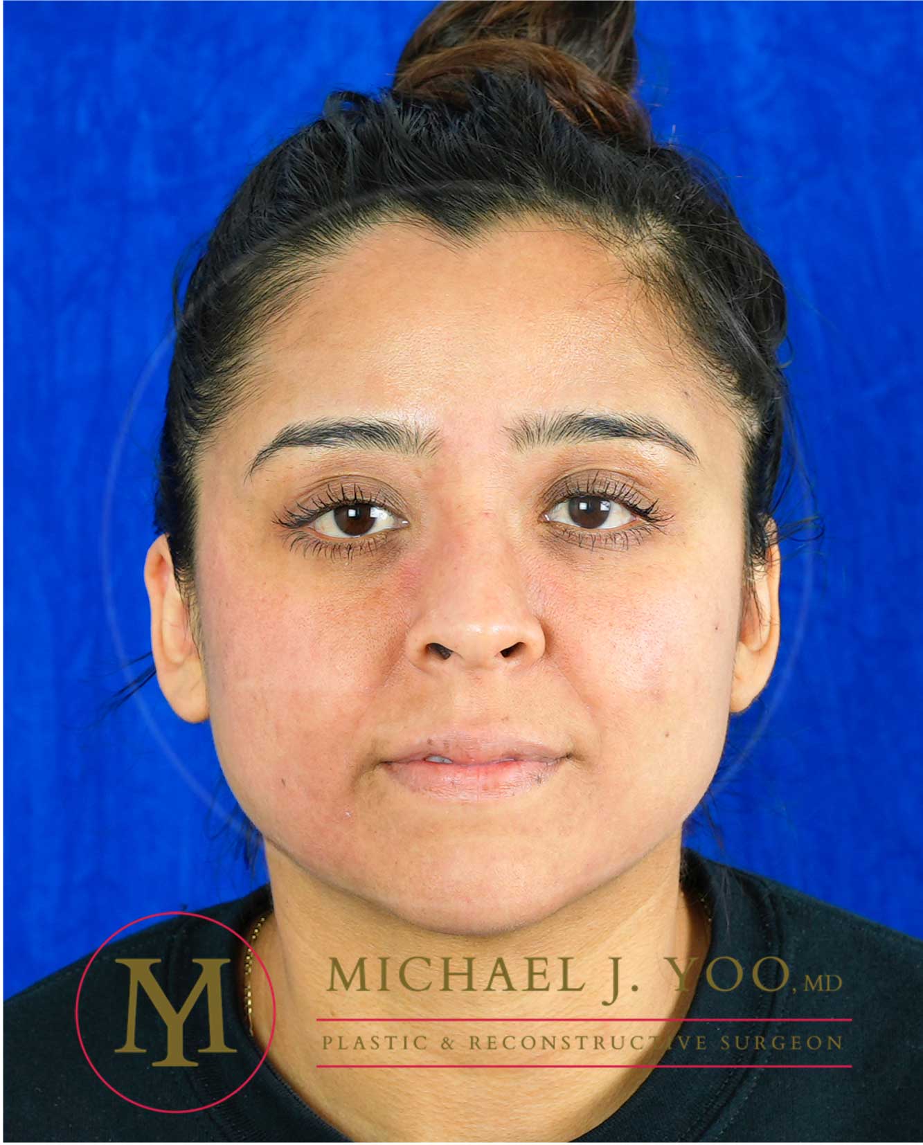 Otoplasty Before & After Patient #3630