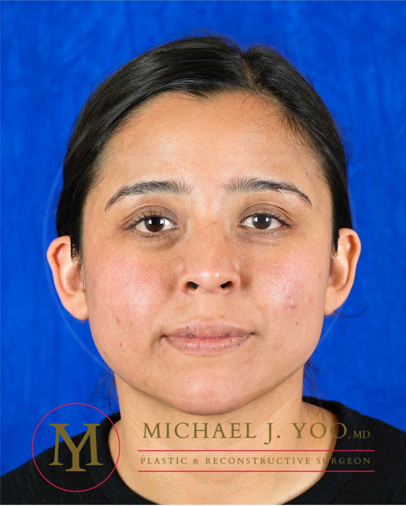 Otoplasty Before & After Patient #3630