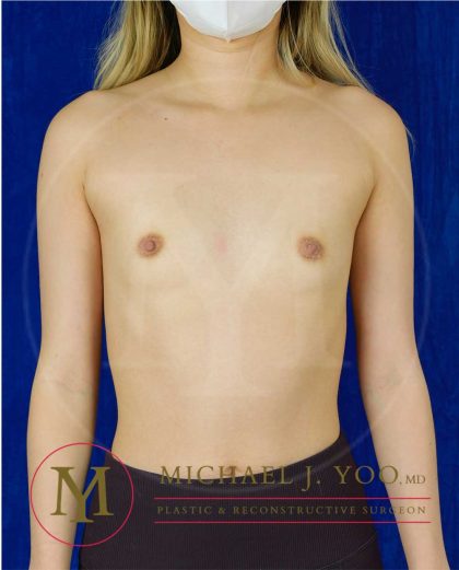Breast Augmentation Before & After Patient #3623